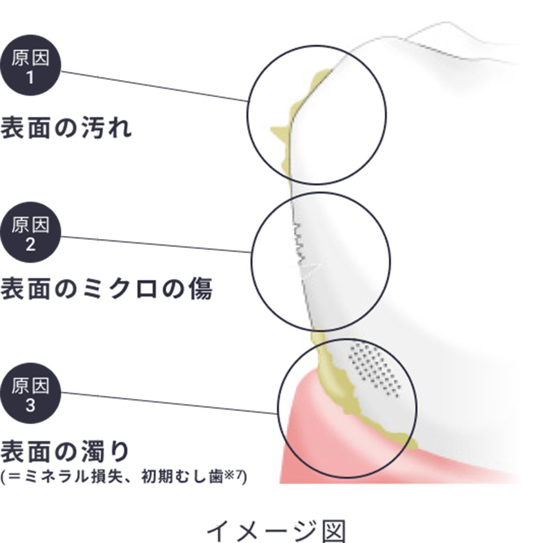 原因１表面の汚れ 原因2表面のミクロの傷 原因3表面の濁り(＝ミネラル損失、初期むし歯※7)イメージ図